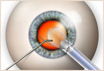 intraocular lens implants